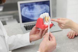 Cost Of Dental Implants In Australia image dubbo