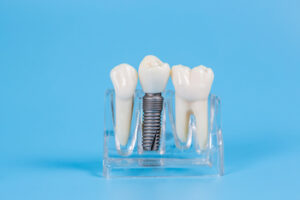 low price tooth implant dubbo