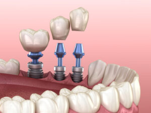 Cost-Of-Single-Tooth-Implants-placement
