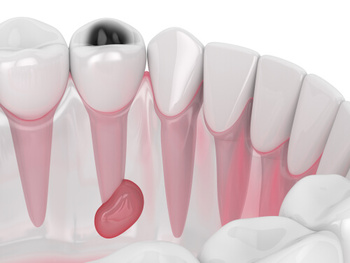 dental implant vs root canal solution