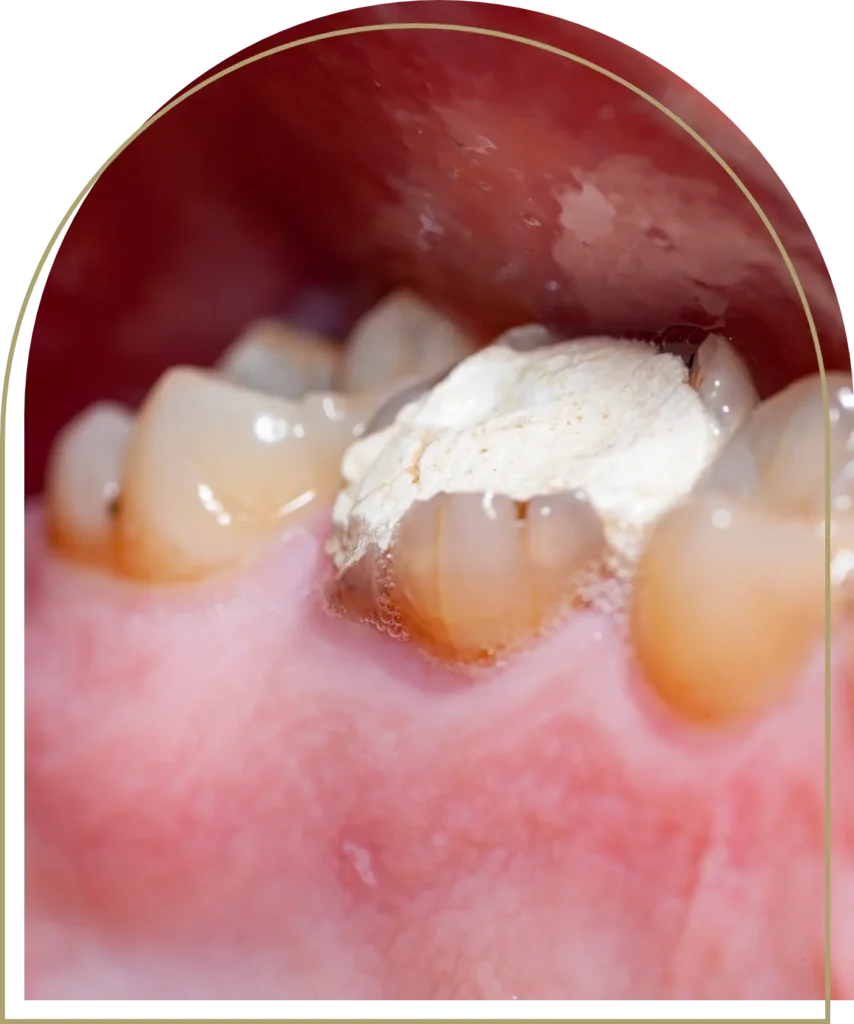 Tooth Fillings dubbo (2)