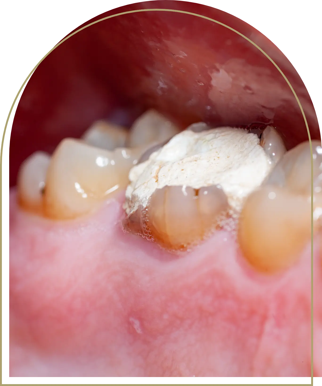 Tooth Fillings dubbo (2)