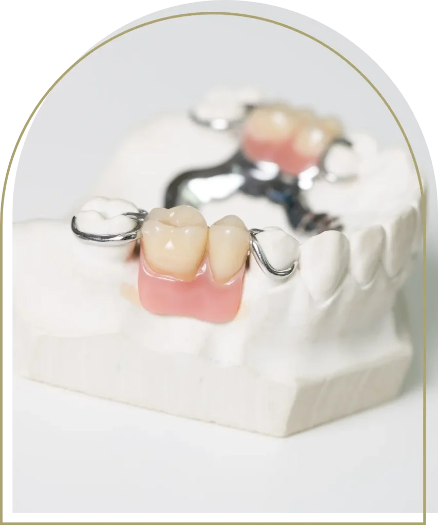 dental Bridges dubbo