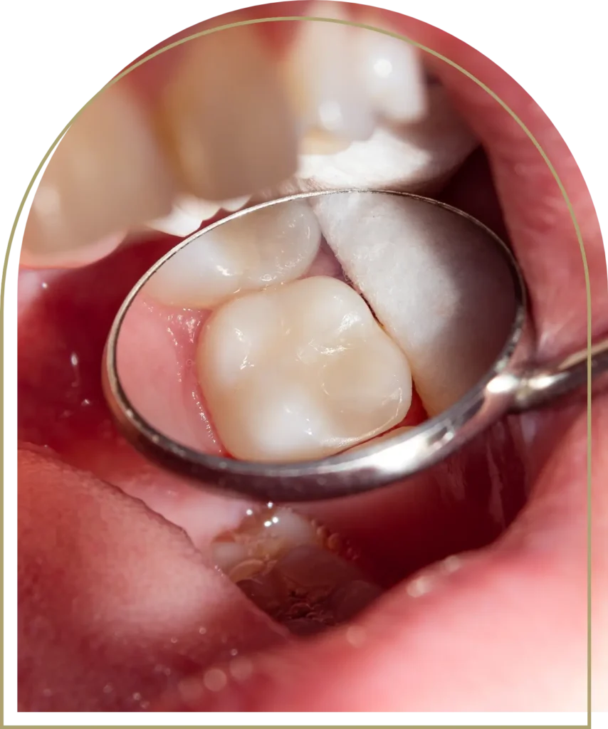 Teeth sensitivity after dental fillings