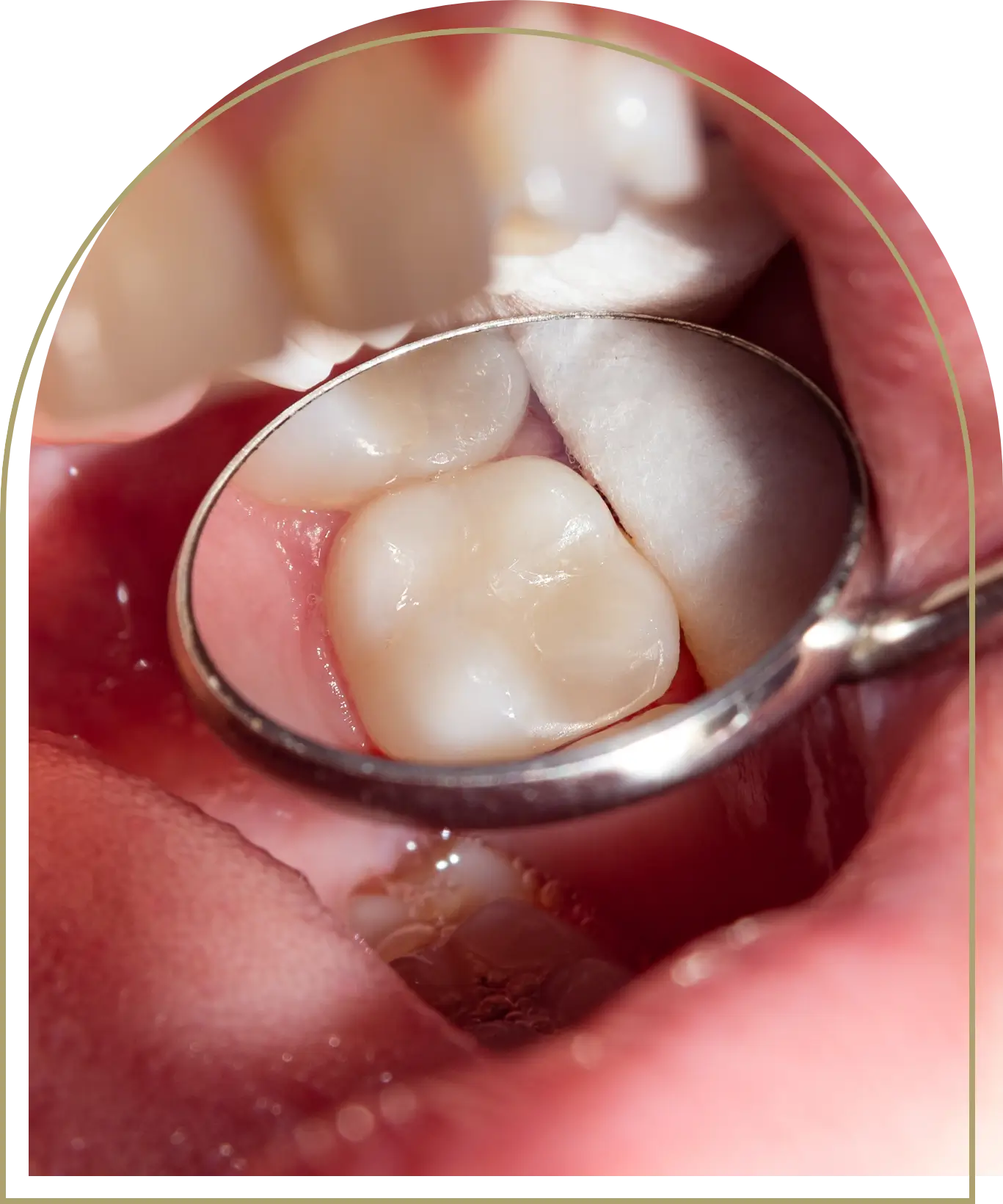 Teeth sensitivity after dental fillings