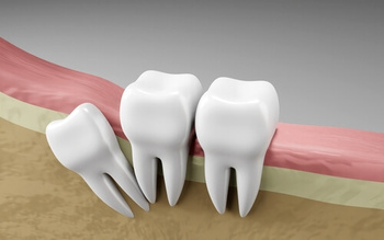 tooth filling cost cavities