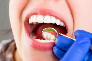 tooth filling cost cavities