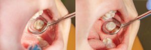 How Long Does a Tooth Filling Last results