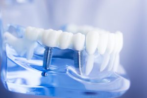 Is a Dental Bridge Permanent implant