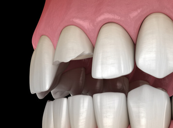 tooth cap vs crown broken