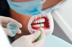 What to Eat After Teeth Whitening professional