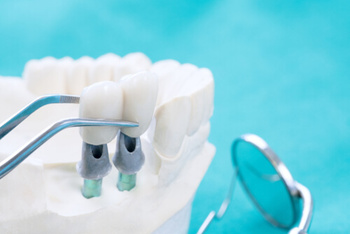Cheap Dental Crowns fabrication