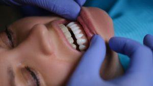 Tooth Decay White Spots on Teeth check