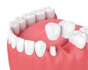 What Is a Dental Bridge procedure
