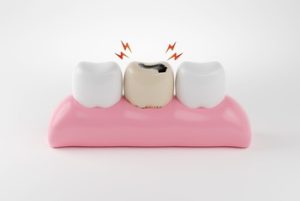 Can Tooth Decay Spread neighbor