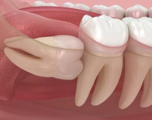 Can Wisdom Teeth Cause Ear and Throat Pain impacted