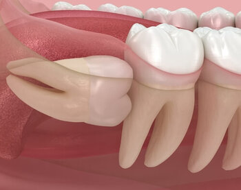 Can Wisdom Teeth Cause Ear and Throat Pain impacted