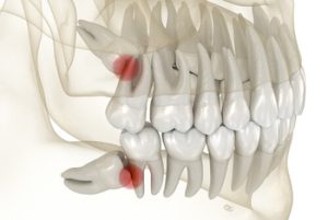 Can Wisdom Teeth Cause Ear and Throat Pain swelling