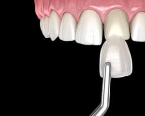Dental Bonding Procedure or veneers