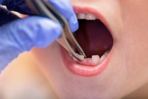 Tooth Extraction White Stuff Fell Out No Pain abcess