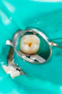 Two,Chewing,Side,Teeth,Of,The,Upper,Jaw,After,Treatment