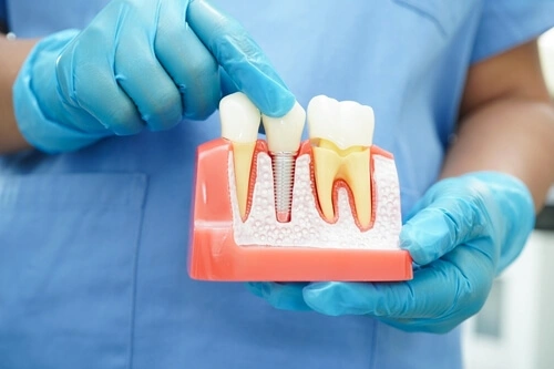 Swelling After Dental Implant Bone Graft procedure