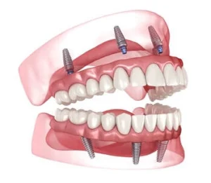 Implant Supported Dentures full arch