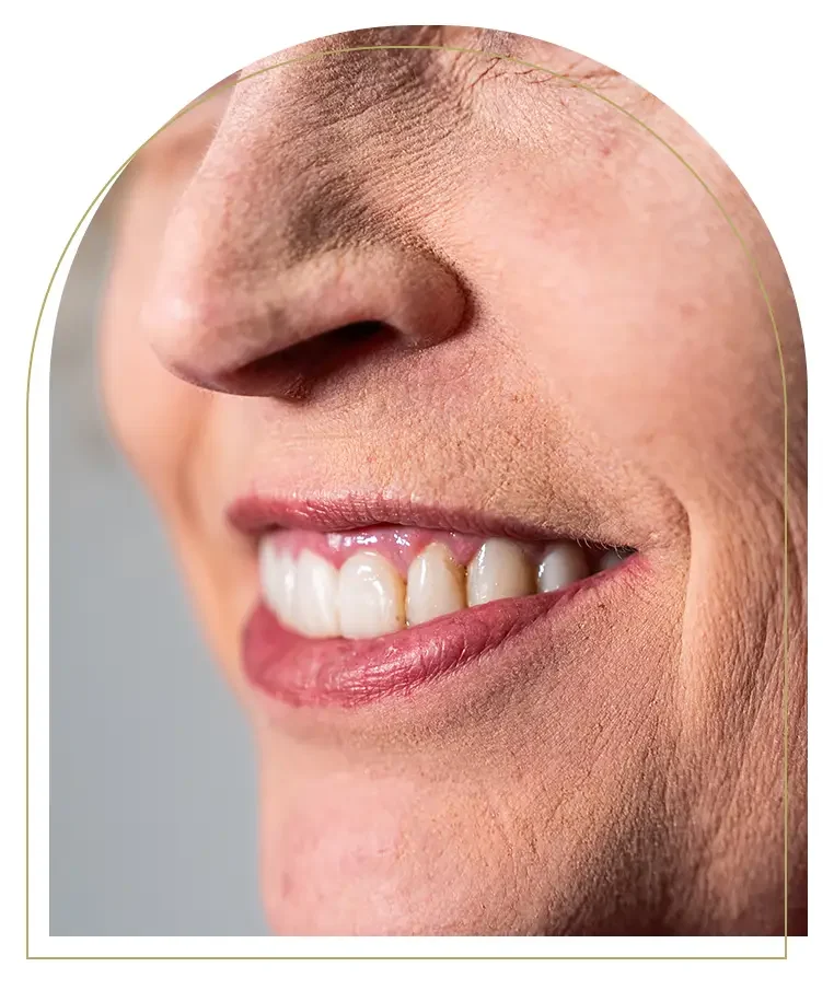 Composite bonding procedure correcting minor crooked front teeth in Dubbo
