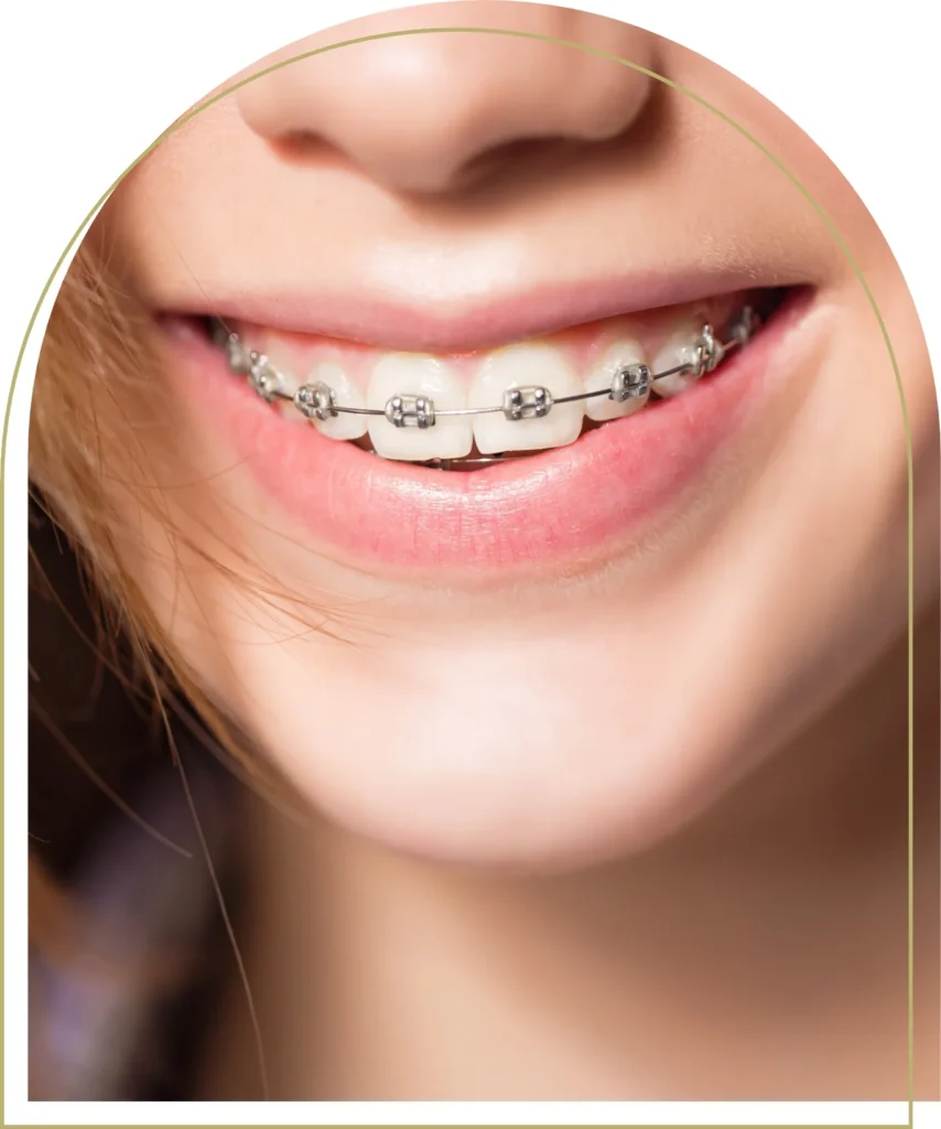 Braces 1.webp