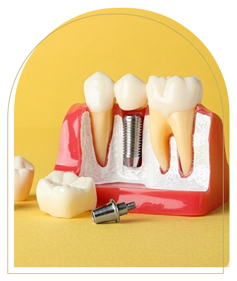 Dental implant model showing a titanium implant replacing a missing tooth in a Dubbo dental clinic