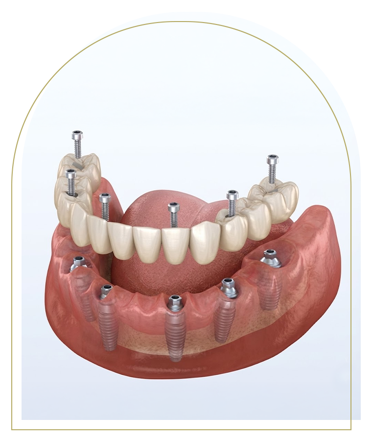 what is all on 4 dental implants​