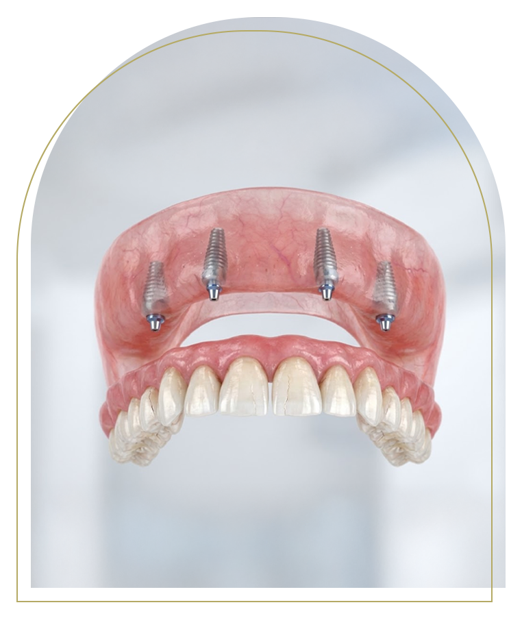 Full arch dental implants with four implant posts supporting teeth in Dubbo