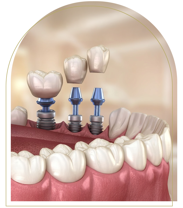 Implant crowns are being placed on dental implants for full tooth restoration in Dubbo