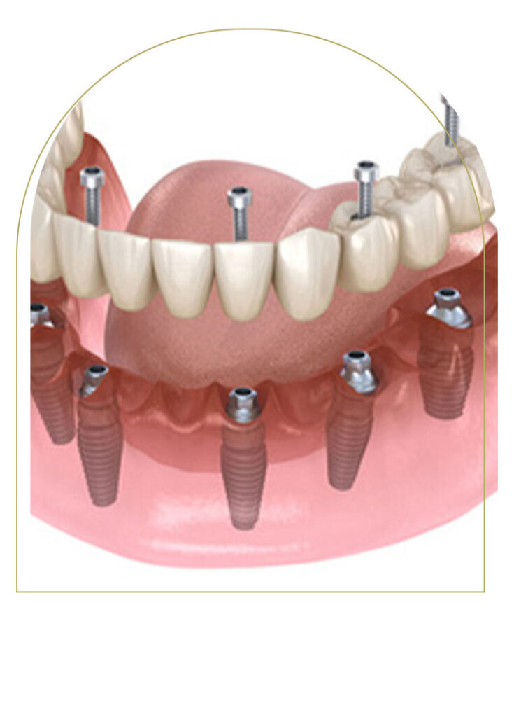 How Long Do Dental Implants Take?