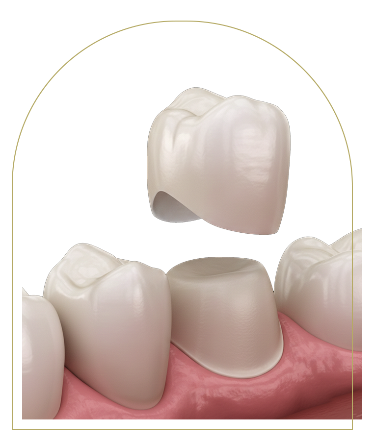 Porcelain Crowns