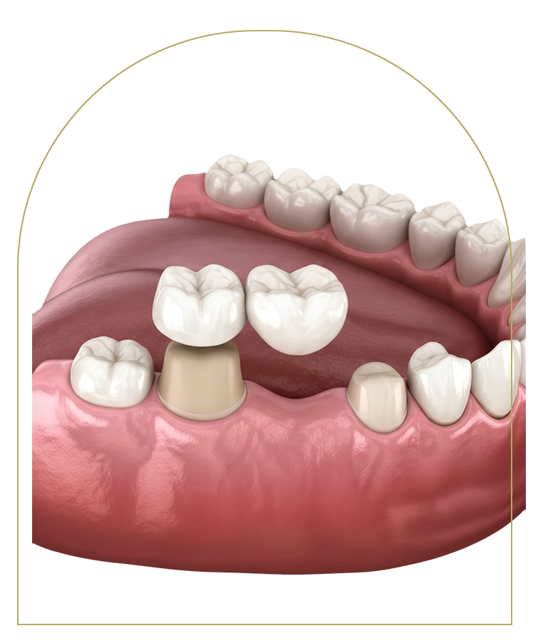 Dental crown and bridge illustration for restorative dentistry in Dubbo.
