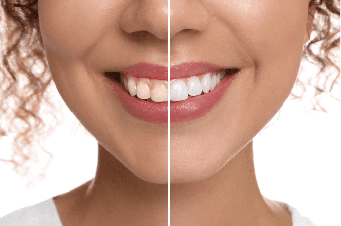 Woman with beautiful smile after composite bonding treatment in Dubbo