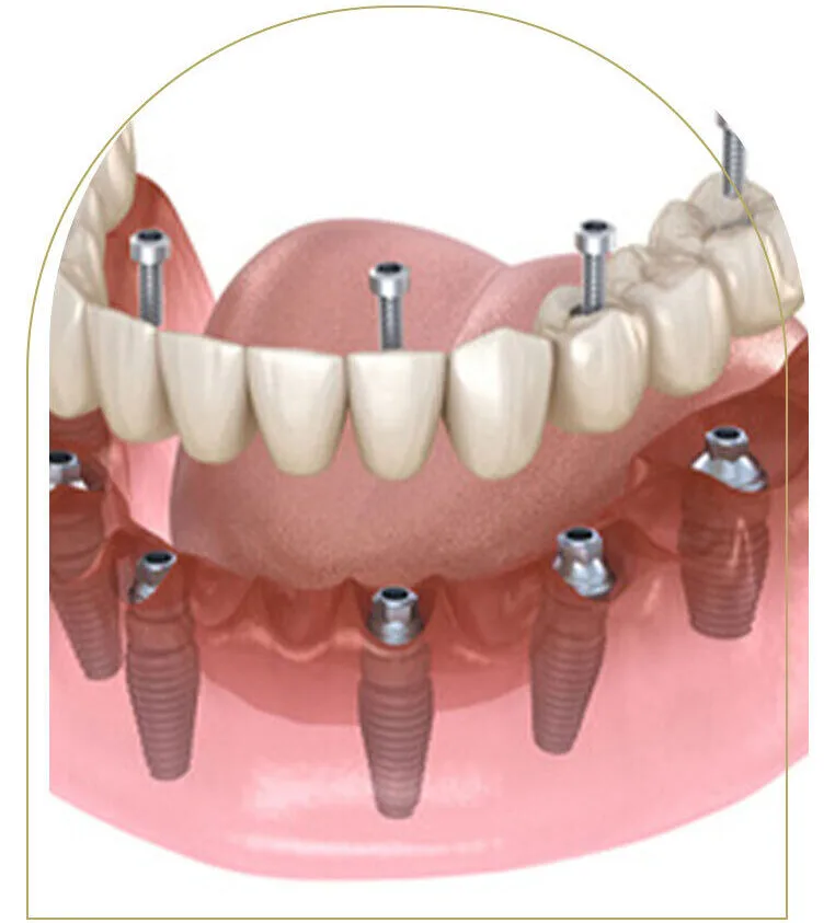 3D diagram of All-on-4 dental implants with titanium posts in jawbone.