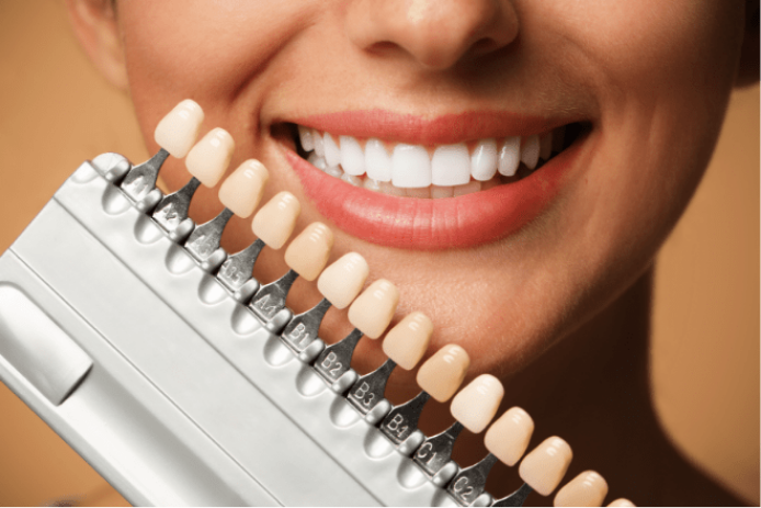 Close-up of natural-looking composite bonding on tooth surface.