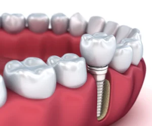 Mosman dentist explaining whether dental implants can cause brain damage to a patient