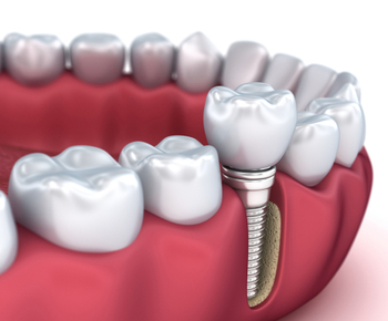 Mosman dentist explaining whether dental implants can cause brain damage to a patient