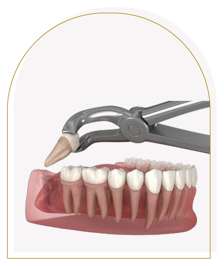 Simple Wisdom Tooth Extraction