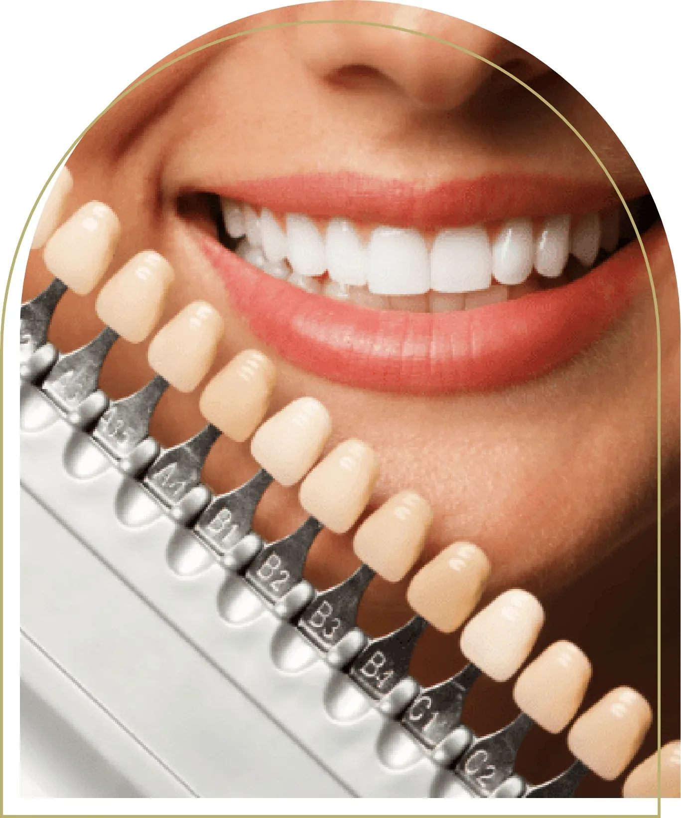 Composite bonding tooth shade guide held against a bright white smile for accurate colour matching