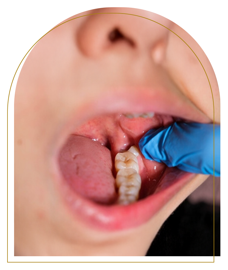 Impacted Wisdom Teeth Removal