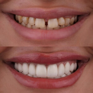 Fixing Gaps Between Teeth