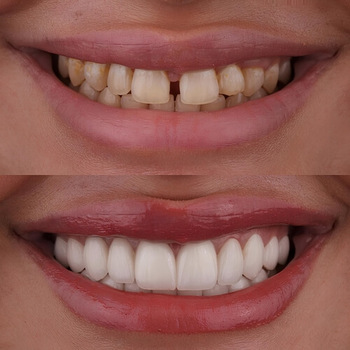 Fixing Gaps Between Teeth